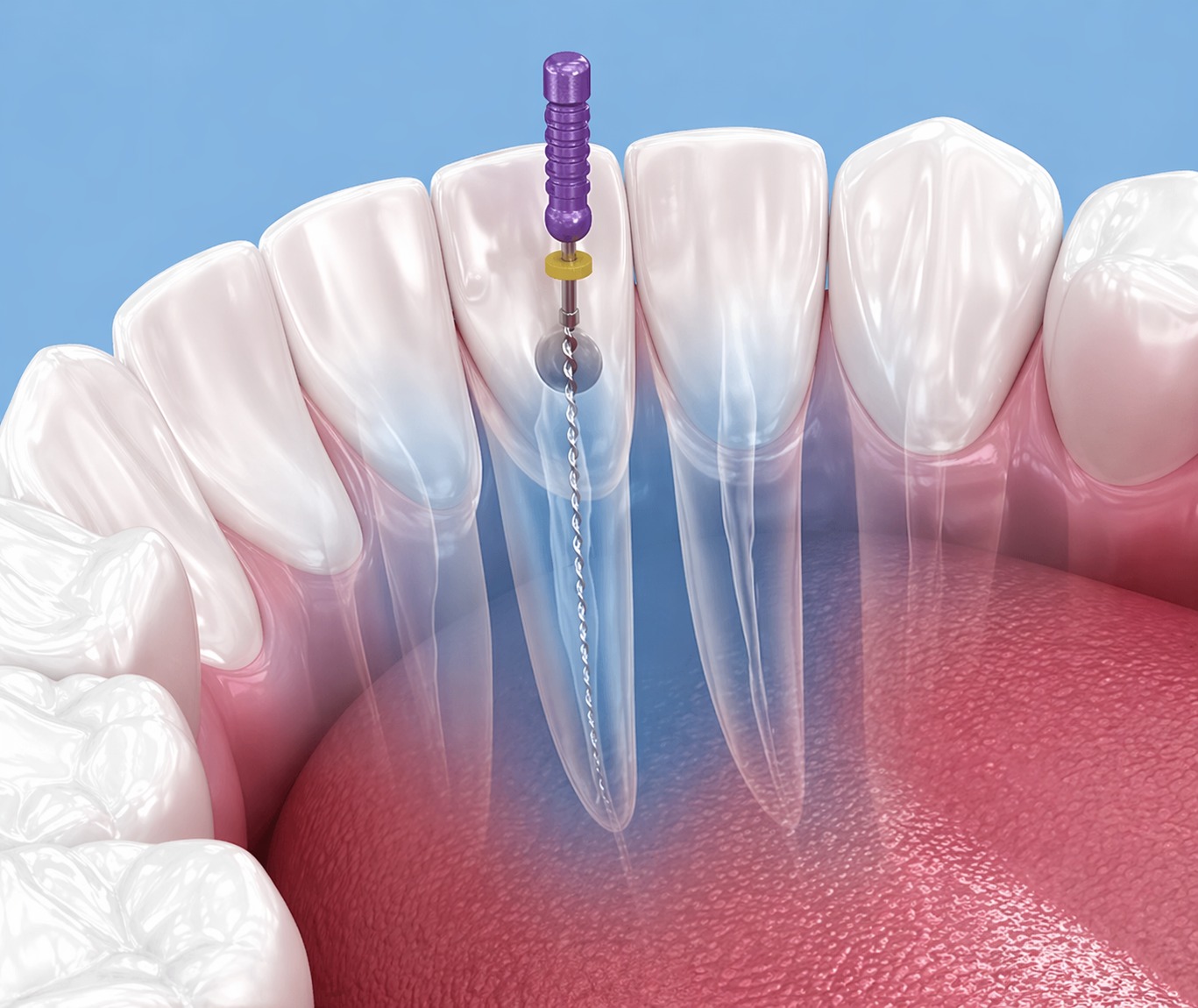 Imagen de endodoncia mecanizada