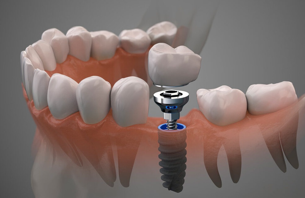 Imagen de implantes