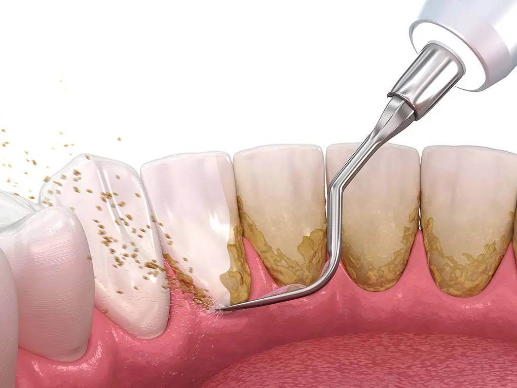 Imagen de periodoncia
